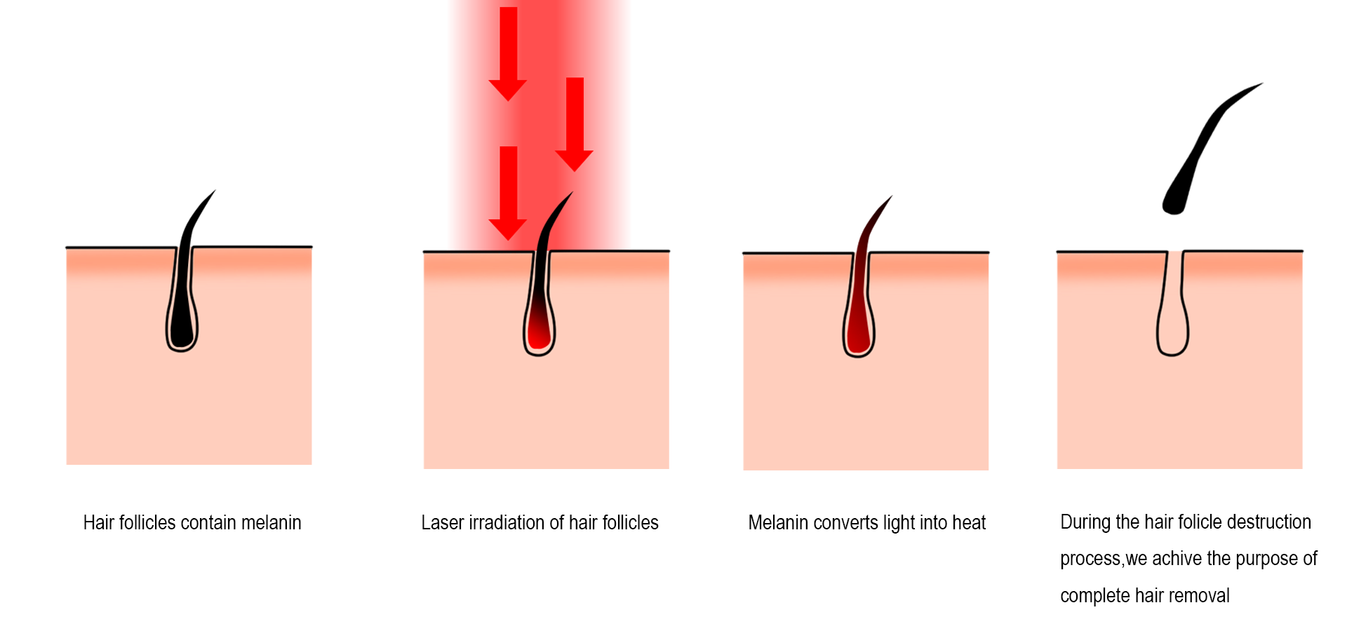 Khatelo-pele ea ho tlosa moriri oa Laser - Mokhoa oa laser o tlosa moriri hantle joang.